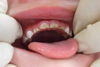 生えたばかりの前歯の虫歯