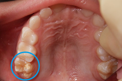 6才臼歯形成不全右上 右奥歯に形成不全がみられます