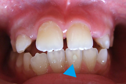 前歯形成不全 白い点の部分が形成不全です