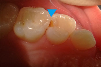 虫歯になりやすい奥歯の歯と歯の間