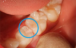 見た目にはわかりにくい歯と歯の間の虫歯の画像