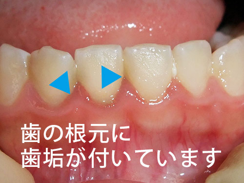 虫歯になりやすい奥歯の歯と歯の間