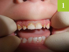 二階堂じゅんこ こども歯科に来院した前歯に虫歯ができてしまった3歳の男の子
