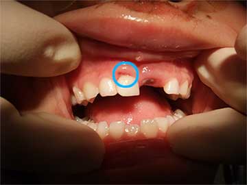 打った歯と歯ぐきの間からの出血の有無が受診すべきかどうかのひとつの目安
