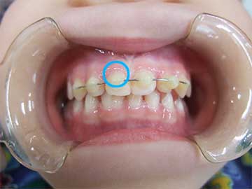 歯のカーブに合わせてワイヤーを曲げ、接着剤で周囲の歯と固定